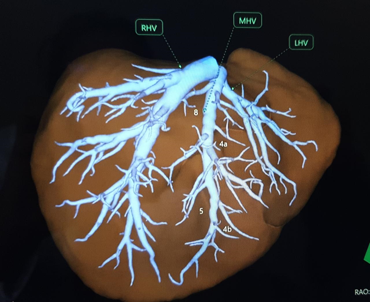 Liver Transplant