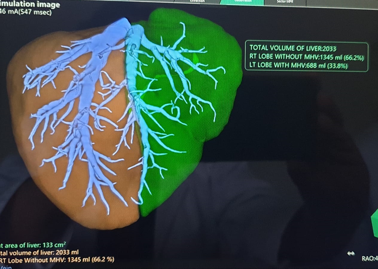 Liver Transplant