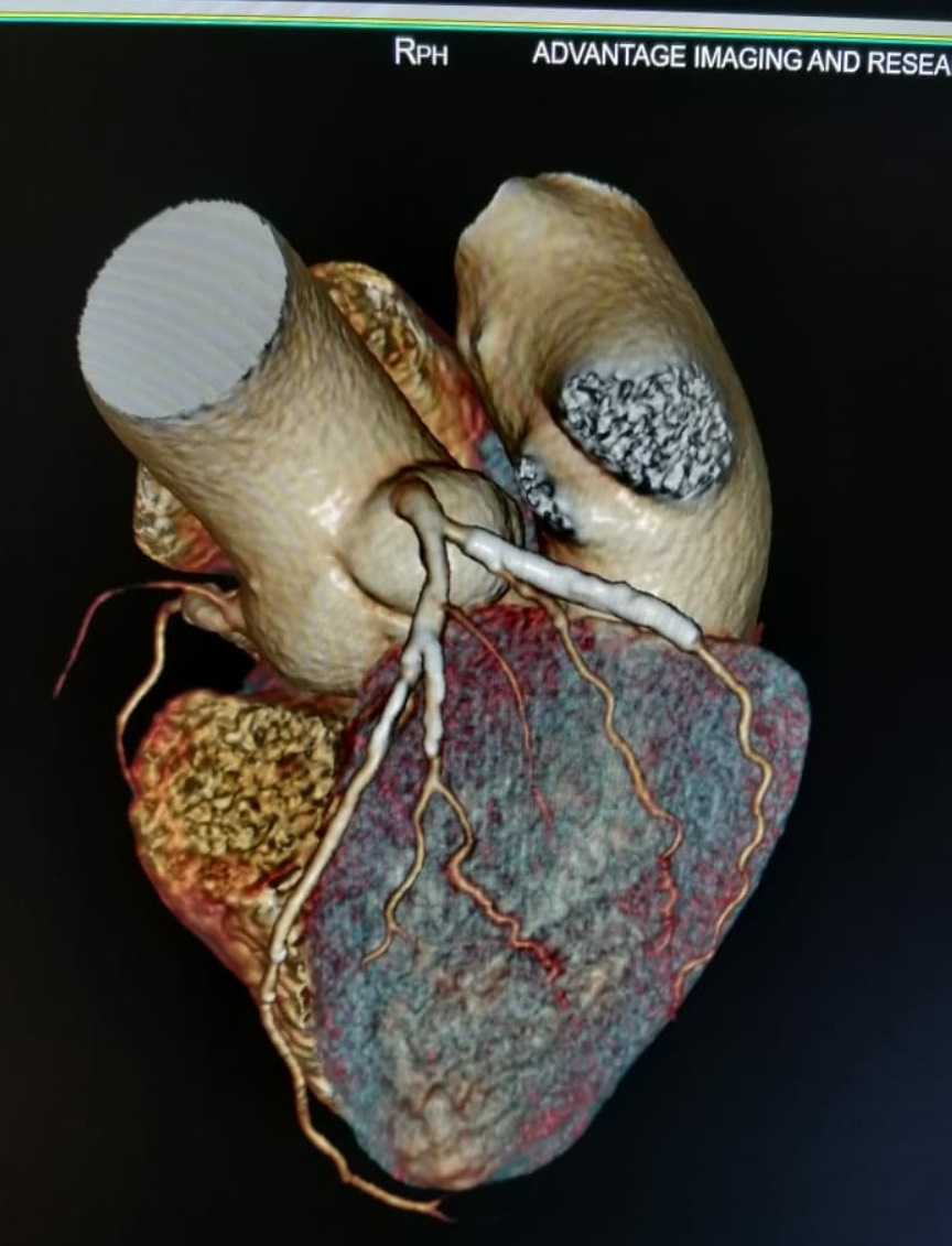 Coronary