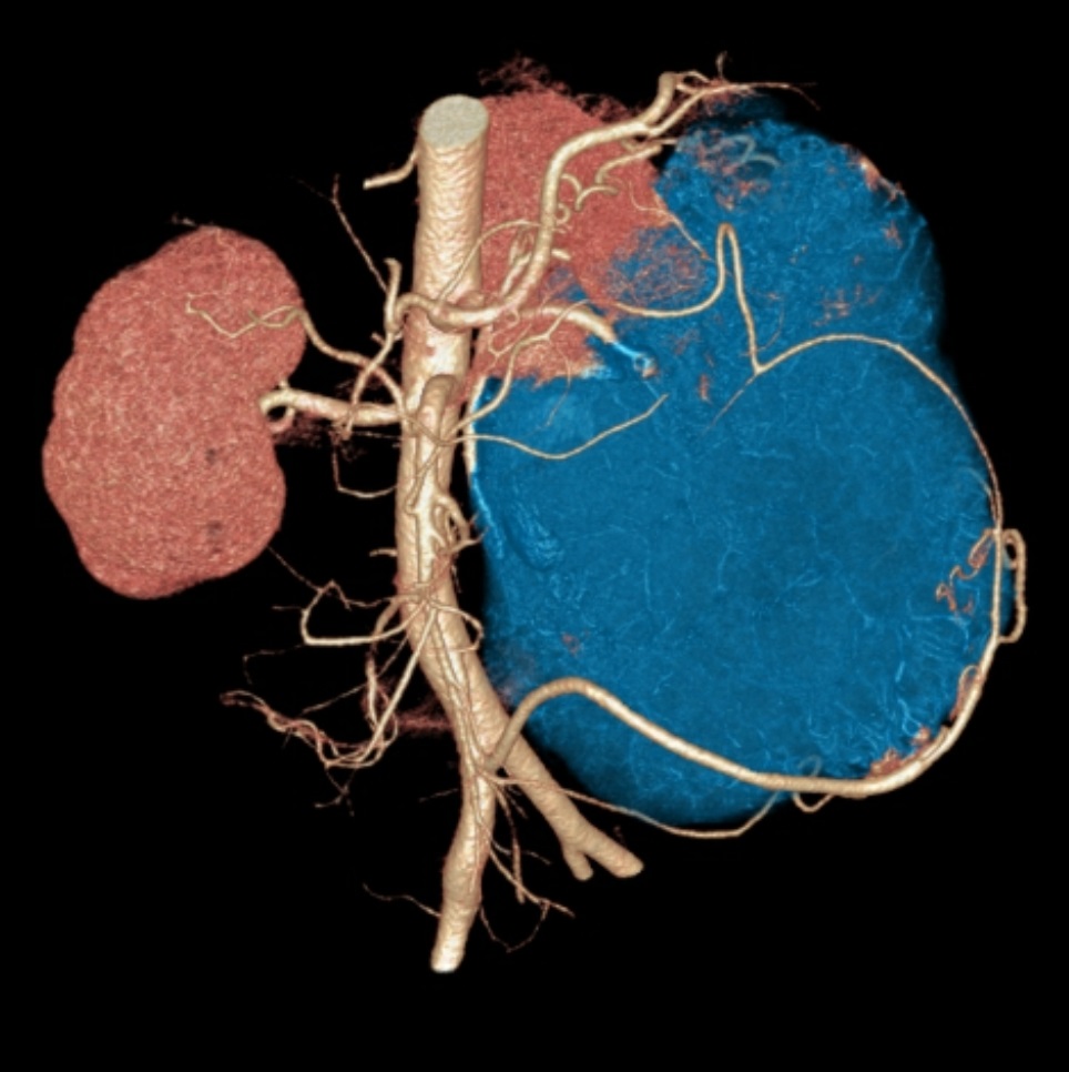 CT Angiogram